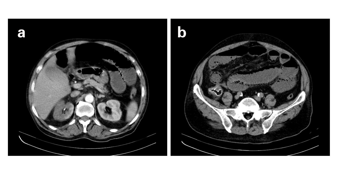 Renal Infarction Three Case Reports and Literature Review Sepulveda